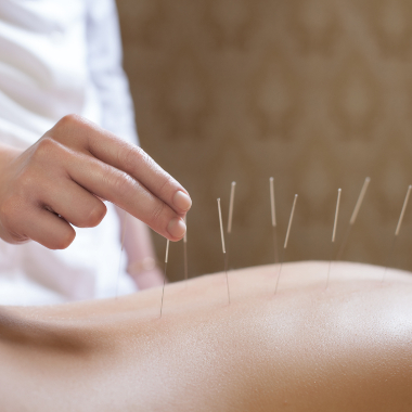 image of acupuncture